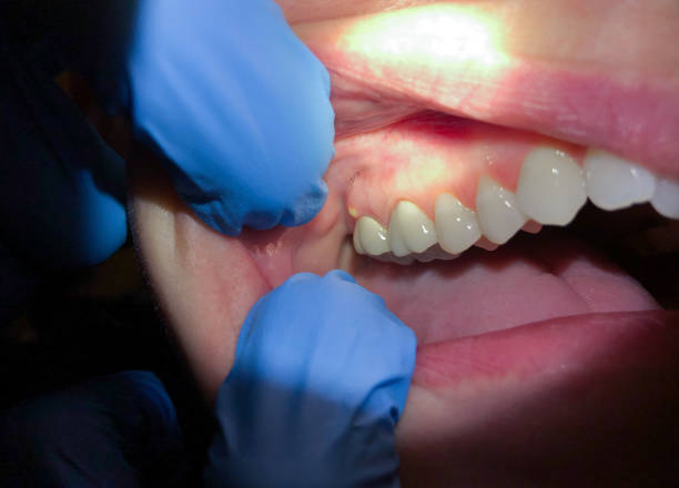 Tooth Infection Emergency Dentist in IN